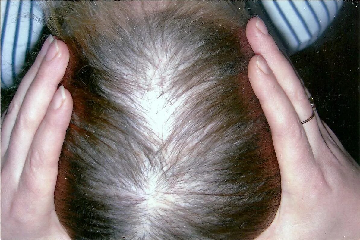Выпадение волос головы причина лечение. Гнёздная (очаговая алопеция). Гнёздная алопеция диффузная. Телогеновая гнездная алопеция.