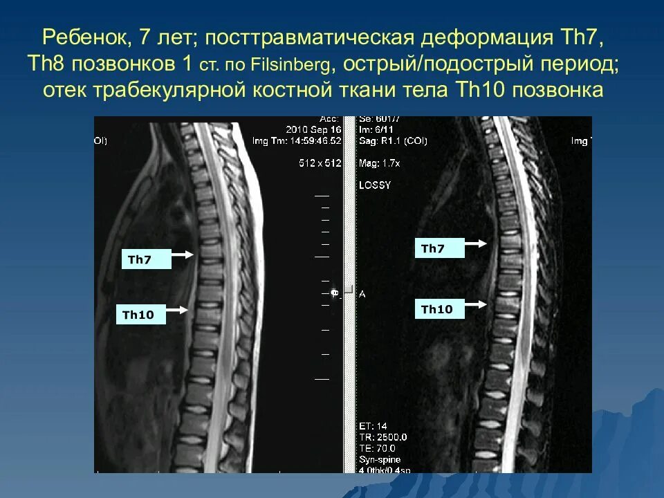 Деформация н к. Клиновидная деформация тела th6 th7 позвонка. диск позвоночника th6-th7. позвонки th7-l2. th3 th10 позвонка.