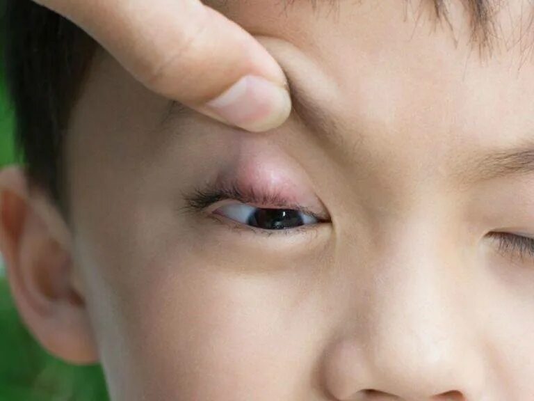 Халязион халязион халязион. Ячмень на глазу уребегка. Ячмень верхнего века у ребенка. Почему вылазит глаз