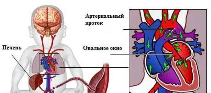 Где находится овальное окно. Артериальный проток и овальное окно. Овальное окно и боталлов проток. Открытый артериальный проток открытое овальное окно. Овальное окно у детей.