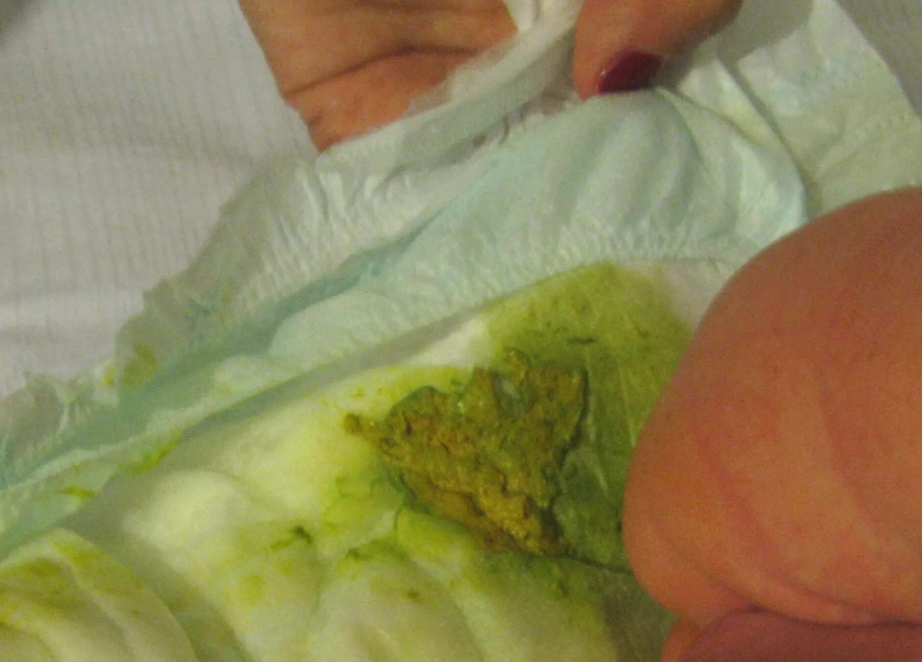 Зеленый понос у грудничка на грудном вскармливании. Зелёный понос у новорожденного на грудном вскармливании. Кал новорожденного меконий.
