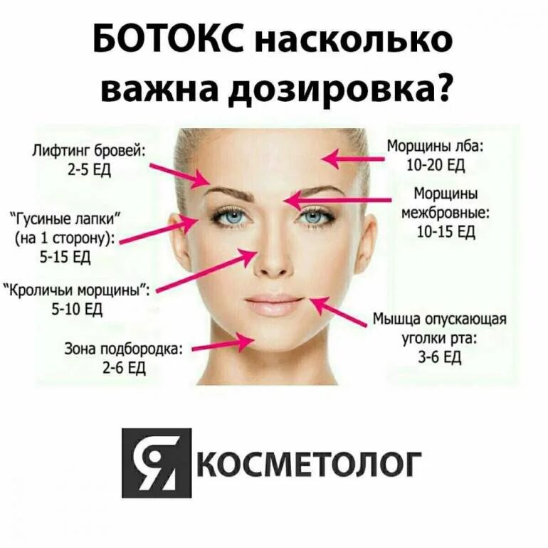 Сколько надо ботокса. Схема введения ботокса в лоб. ботокс в лоб схема введения. точки введения ботокса в лоб. схема уколов ботокса на лице.