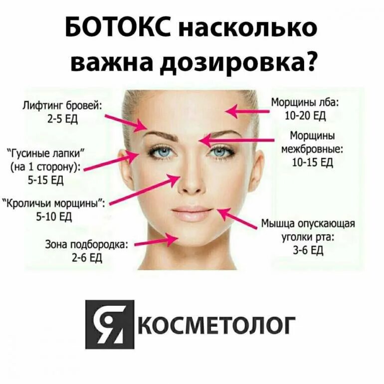 Сколько единиц ботокса в лоб. Схема уколов ботокса. Схема введения ботокса. Ботокс в лоб схема введения. Схема уколов ботокса на лице.