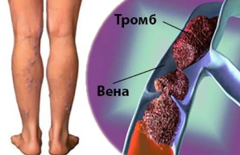 Что значит оторвался тромб у человека. Тромбофлебит подколенной вены. тромб в подколенной вене. тромбоз глубоких вен симптомы.