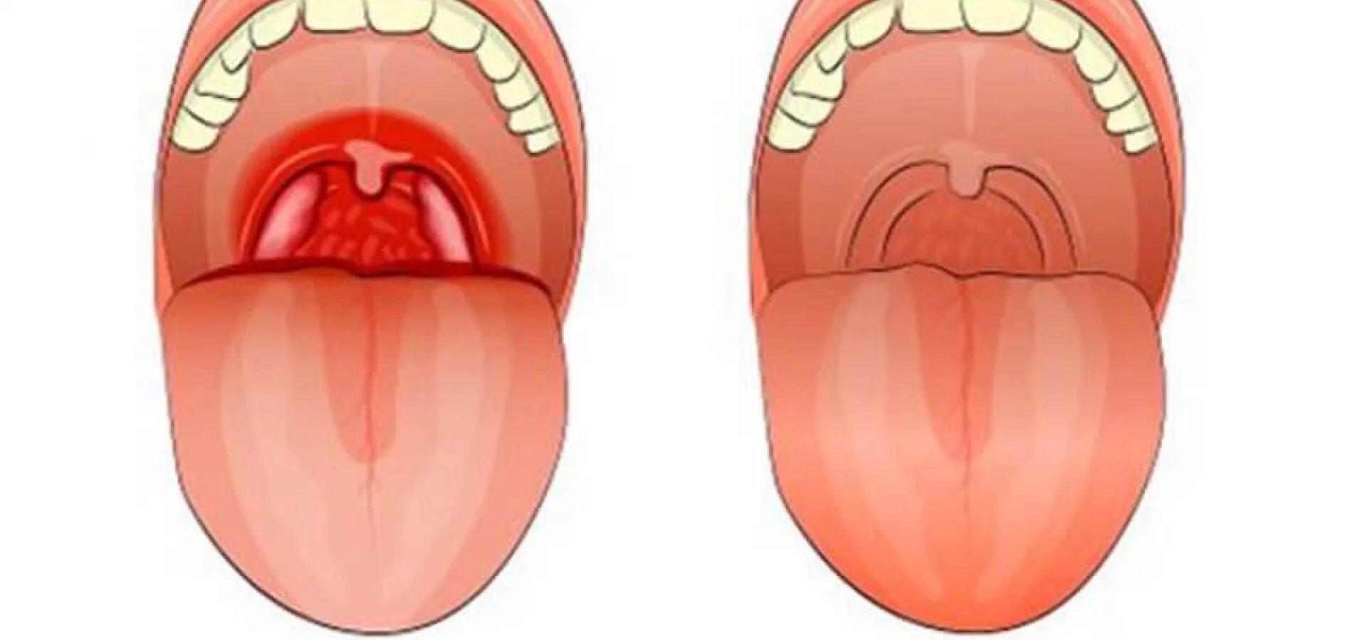 Какой там рот. Хронический тонзиллит миндалины. Воспаленная небная миндалина.