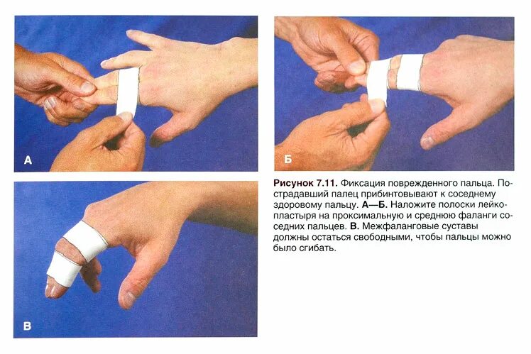 Ушиб фаланги пальца на руке как выглядит mallet-finger