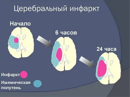Зоны инсульта