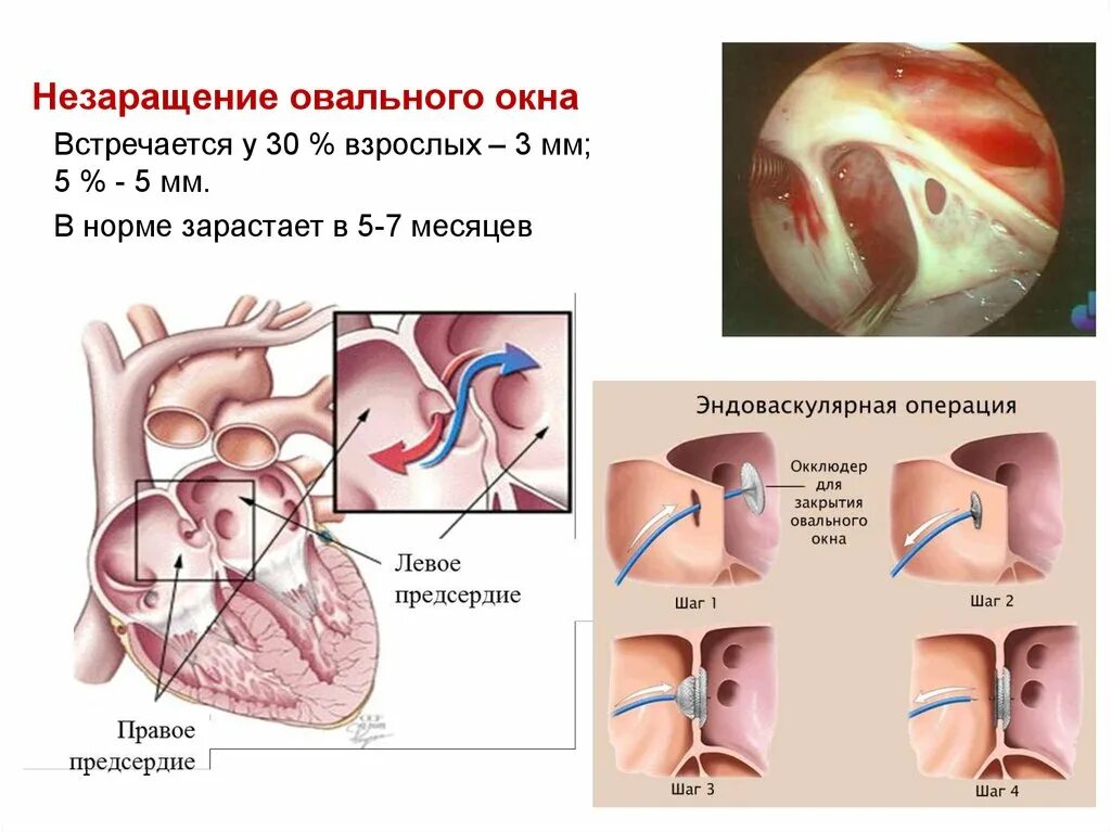 Где находится овальное окно. Открытое овальное окно у новорожденного норма. Открытое овальное окно в сердце. Открытое овальное окно в сердце у ребенка. Открытое овальное окно 6 мм у грудничка.