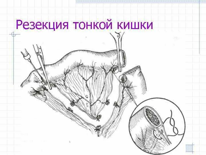 Резекция сегмента. Резекция сегмента
