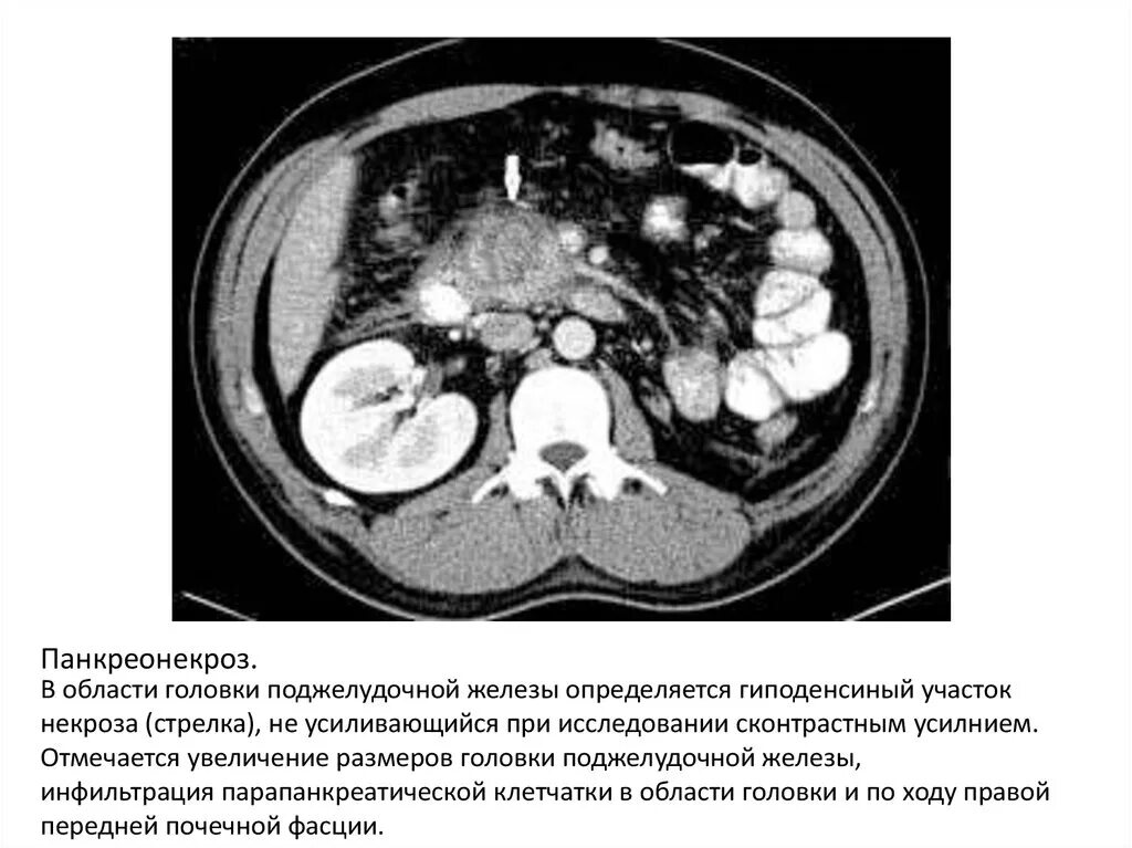 Парапанкреатическая клетчатка что это значит. Парапанкреатическая клетчатка что это значит
