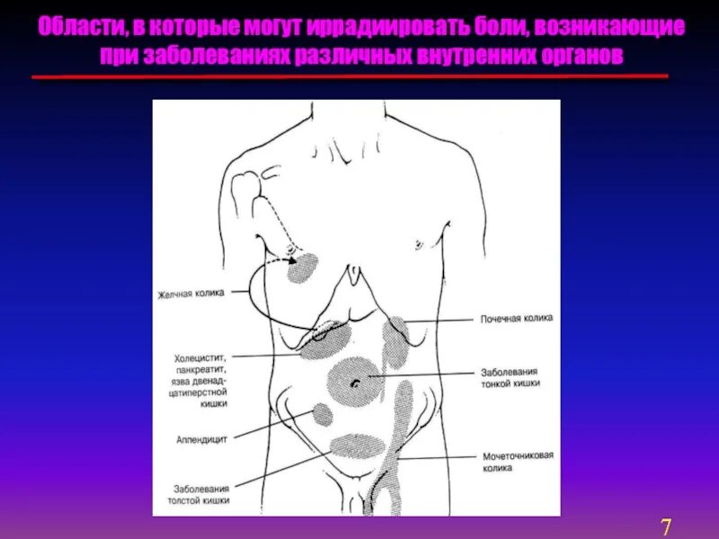 Симптом иррадиации. Абдоминальная боль. Иррадиация абдоминальной боли. Иррадиация боли при поражении внутренних органов. Иррадиирующая боль в животе.