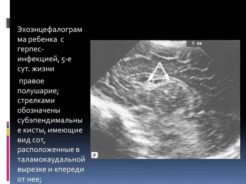 Субэпендимальная киста у новорожденного. Субэпендимальная киста головного мозга у новорожденного. Субэпендимальная киста на узи. Узи нейросонография новорожденных. Субэпендимальная киста на узи.