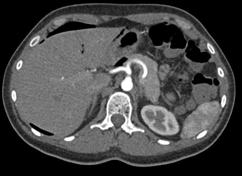 Кт брюшной полости и забрюшинного пространства. Кт брюшной полости (контрастирование. Кт брюшной полости метастазы. РКТ брюшной полости.