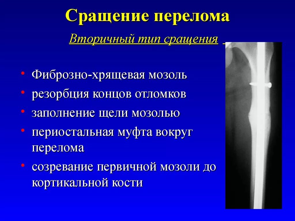 Рентген костная мозоль пере. Этапы сращения перелома.