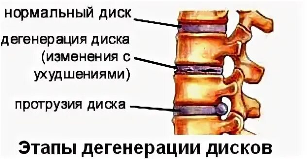 Протрузии отдела позвоночника. Картинка протрузия позвоночника. Протрузия поясничного отдела позвоночника. Протрузия спондилез дисков.