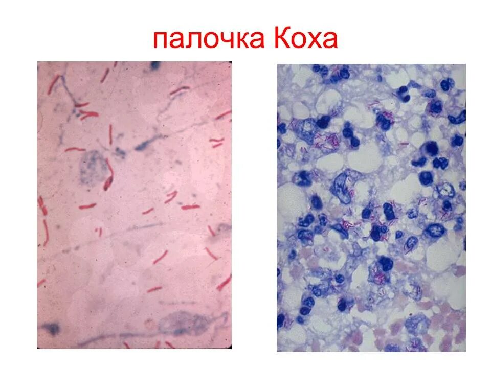 Окраска по граму микробиология. Палочки коха туберкулез микроскопия. Микобактерии туберкулеза микробиология. Mycobacterium leprae окраска по граму. Микобактериозы туберкулеза окраска по цилю нильсену.