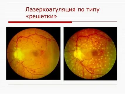 Восстановление сетчатки после операции