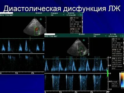 Нарушение релаксации левого