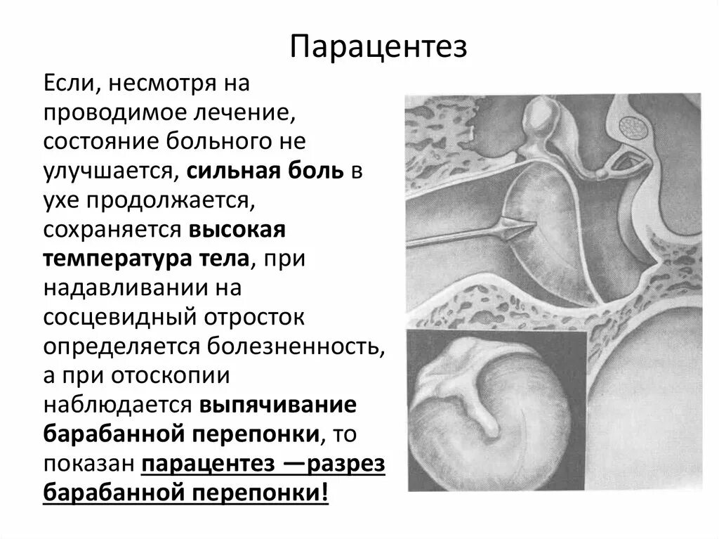 Показания к парацентезу барабанной перепонки. Парацентез разрез барабанной перепонки. "Протокол операции парацентез" барабанной перепонки. Эндоскопия барабанной перепонки перфорация.