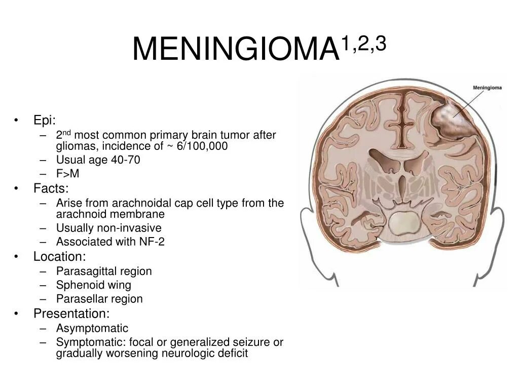 Менингиома головного мозга. Менингиома головного мозга описание.