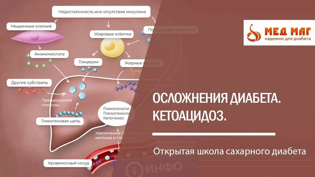 Сахарный диабет с кетоацидозом. Осложнения кетоацидоза. Диабетический кетоацидоз осложнения. Сахарный диабет 1 типа кетоацидоз.