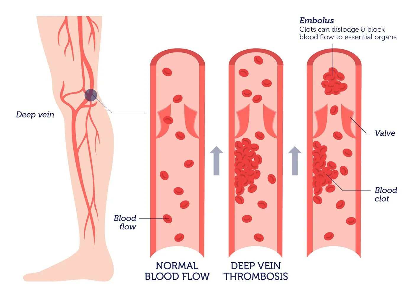 Тромбоз кровеносных сосудов. Тромбоз механизм тромбообразования. Тромбоз вен нижних конечностей патогенез. Тромбоз глубоких вен нижних конечностей этиология. Сосудистые тромбы