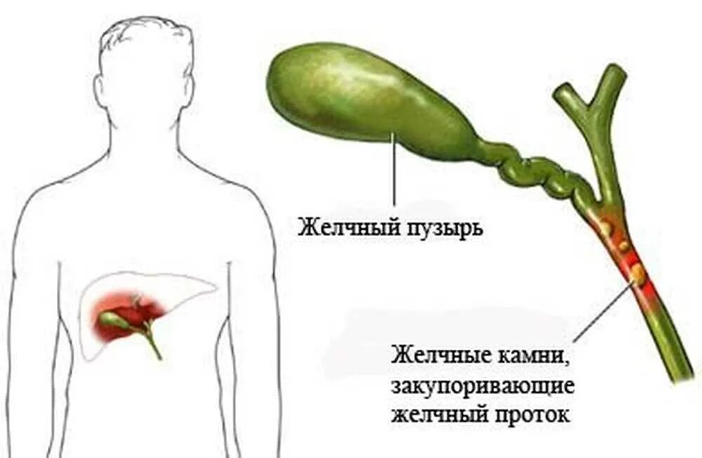 Желчный пузырь симптомы заболевания. Холецистит анатомия желчного пузыря. желчный пузырь болезни перегиб. хронический холецистит симптомы. перекрут желчного пузыря.