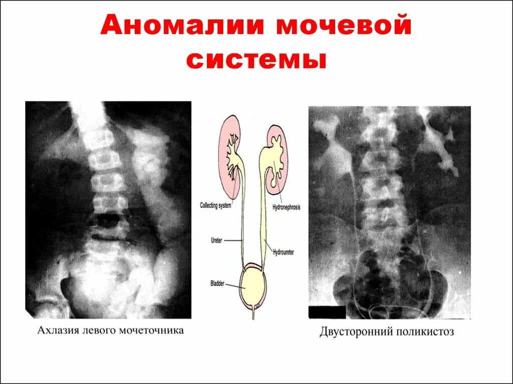 Аномалия мочевого. Пороки развития мочевой системы. Аномалии мочевыводящей системы. Аномалии развития мочевыводящих путей.