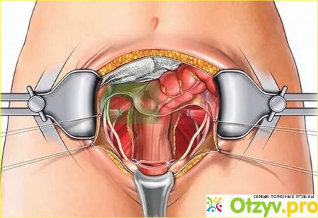 Гистерэктомия что это такое простыми. Операция удаление матки. Полостная операция на матке.