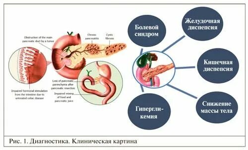 Признаки хронического панкреатита. Клиническая картина при остром панкреатите. Клинический симптом хронического панкреатита. Причины хронического панкреатита у детей. Клинические формы хронического панкреатита.