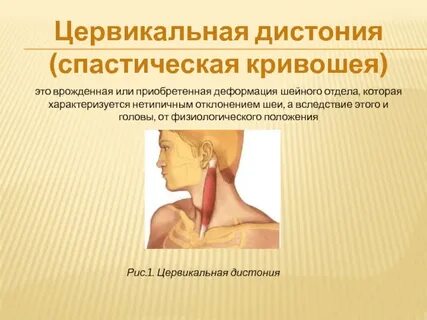 Спастическая кривошея