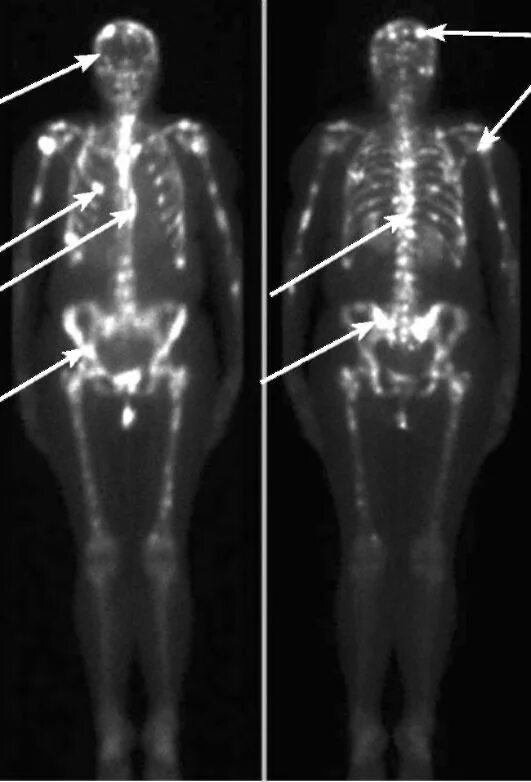 Сцинтиграфия метастазы в кости. Остеосцинтиграфия костей метастазы. Сцинтиграфия костей скелета с метастазами. Остеосцинтиграфия метастазы в костях. Кости позвоночника бедро и печень