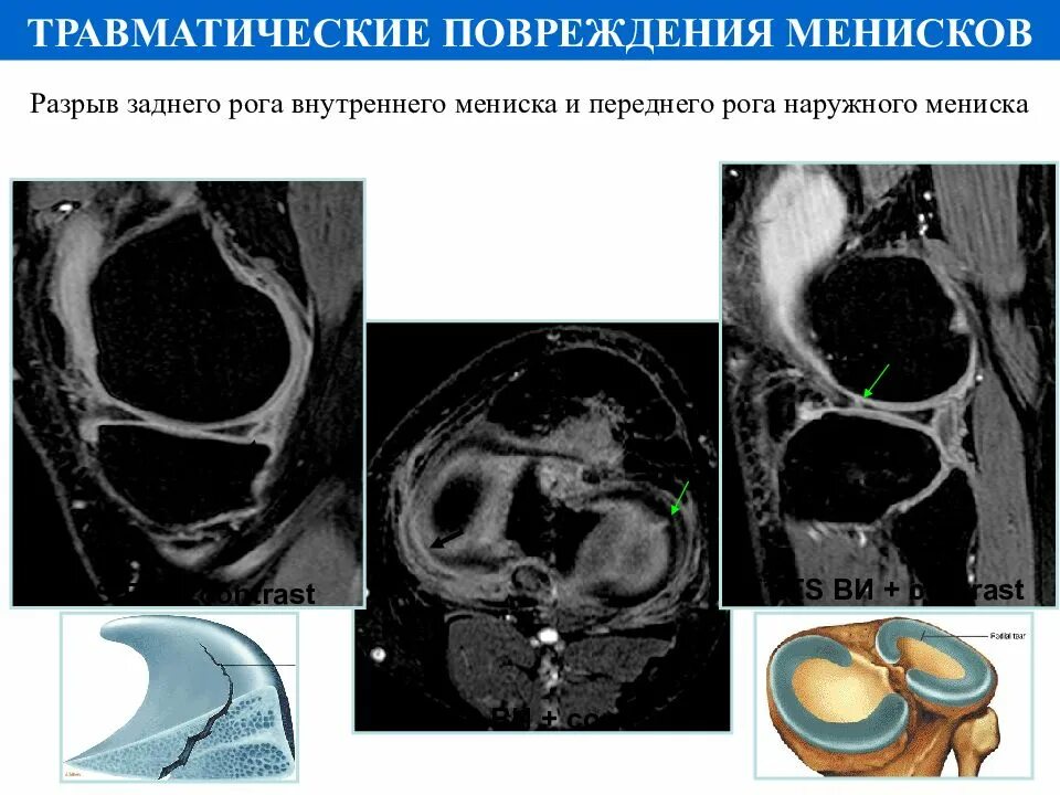 Структурные изменения заднего рога мениска. Задний Рог мениска повреждение. Разрыв переднего рога латерального мениска. Мрт коленного сустава разрыв мениска.