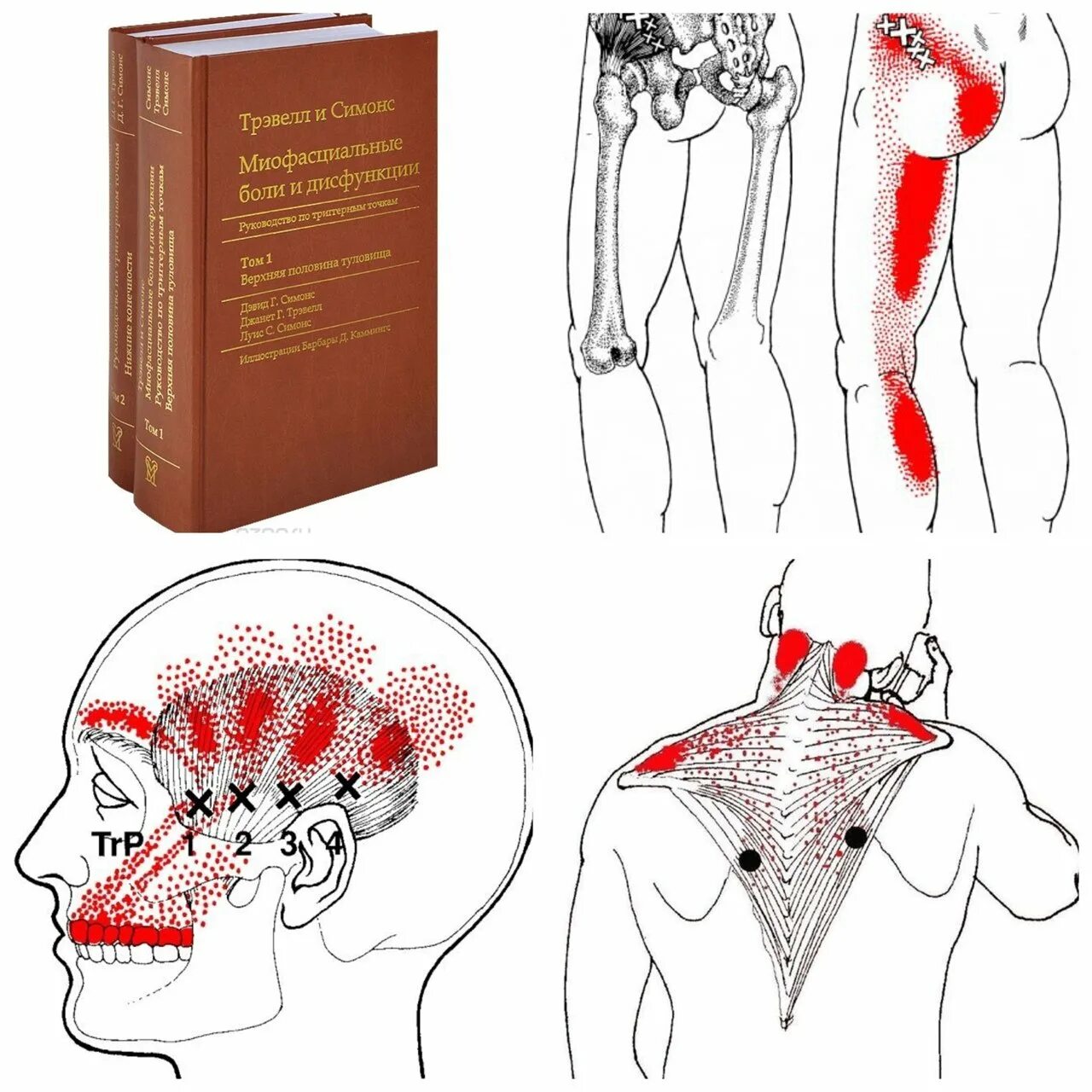 Миофасциальный синдром триггерные точки. Миофасциальный болевой синдром триггерные точки. Миофасциальный синдром триггерные точки спины. Мышцы боли триггерные точки. Триггерные точки это простыми словами