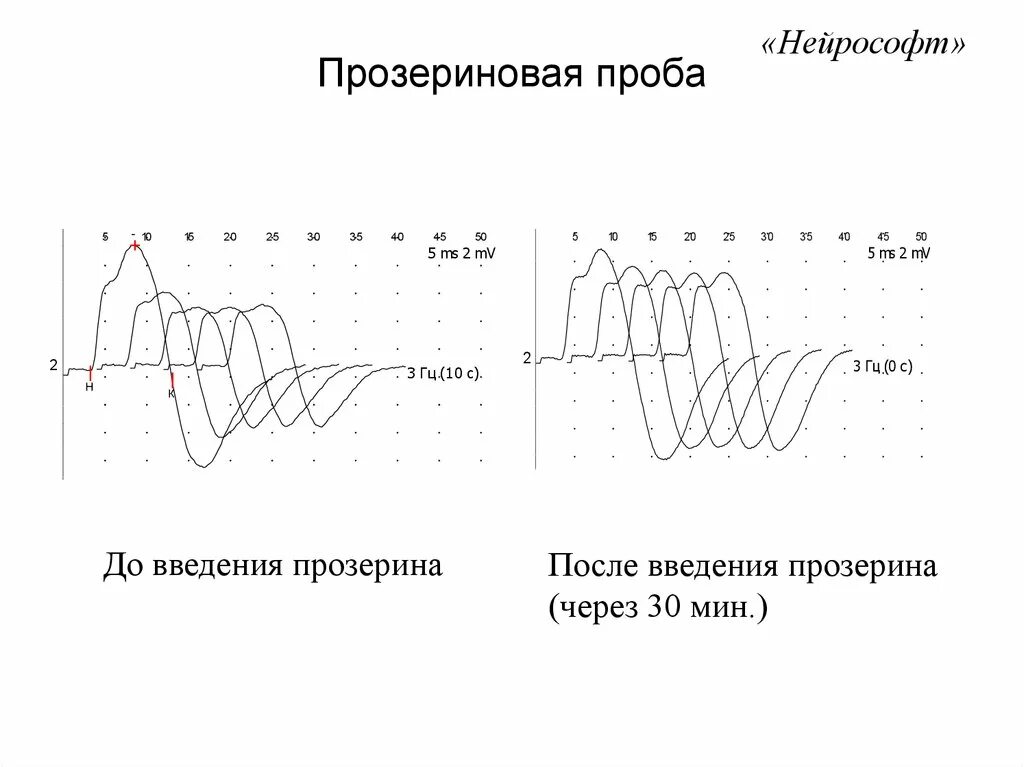 Декремент тест ЭНМГ. Прозериновая проба. Миастения декремент тест. Декремент при миастении.