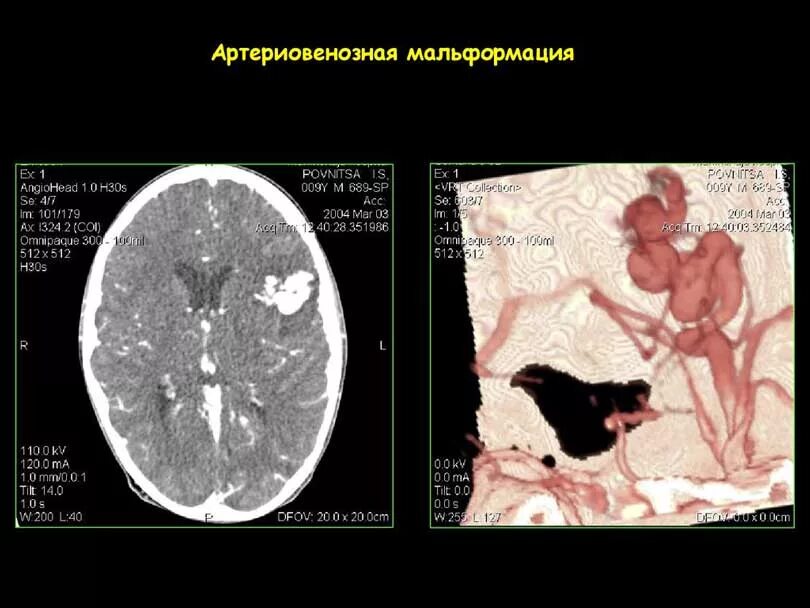 Мальформация сосудов. Артериовенозные мальформации (авм) головного мозга.. атриовентрикулярная мальформация. артериовенозные мальформации головного мозга кт. артериовенозная мальформация сосудов головного мозга гистология.
