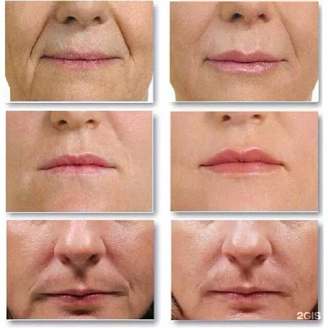 асимметрия складок у ребенка. несимметричные складки на бедрах у малыша. асимметричные складки у ребенка. складки по углам. складки у грудничка на ножках.