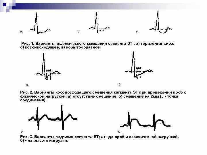 Депрессия сегмента st. Корытообразный сегмент St на ЭКГ. Ишемическое смещение сегмента St что это такое. Корытообразное смещение St. Косонисходящая депрессия сегмента St.