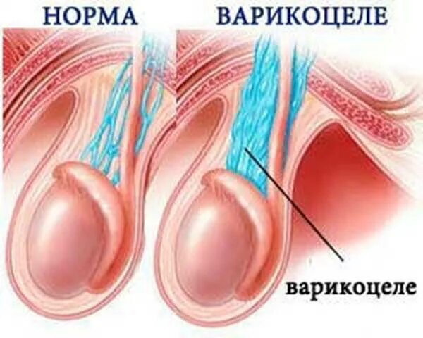 Сплетение яичка. Варикоцеле расширение вен. Варикоз вен семенного канатика. Варикоцеле семенного канатика.