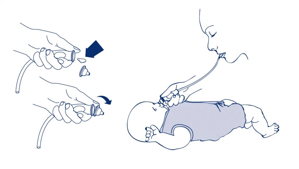 Срыгивает через нос и рот. Отсасывание слизи у новорожденного аспиратором. Отсасывание слизи из носа. Для отсасывания слизи из носа ребенка используют. Как правильно пользоваться аспиратором для детей.