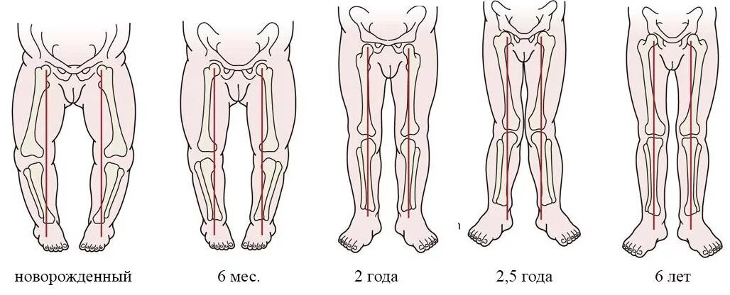 Ноги ребенка по возрасту. Варус вальгусная деформация. Вальгусная и варусная деформация. Вальгусная деформация х образные ноги.