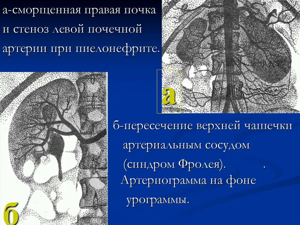 Сегменты правой почки
