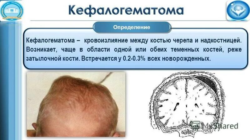 Ушиб мягких тканей головы. Ушиб мягких тканей головы