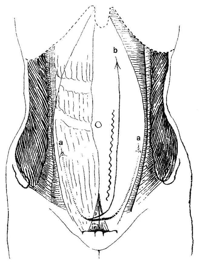 Лапаротомия что это такое простыми словами. Широкая срединная лапаротомия. Постумбиликальная лапаротомия. Диагностическая лапаротомия в гинекологии. Лапаротомия миомэктомия.