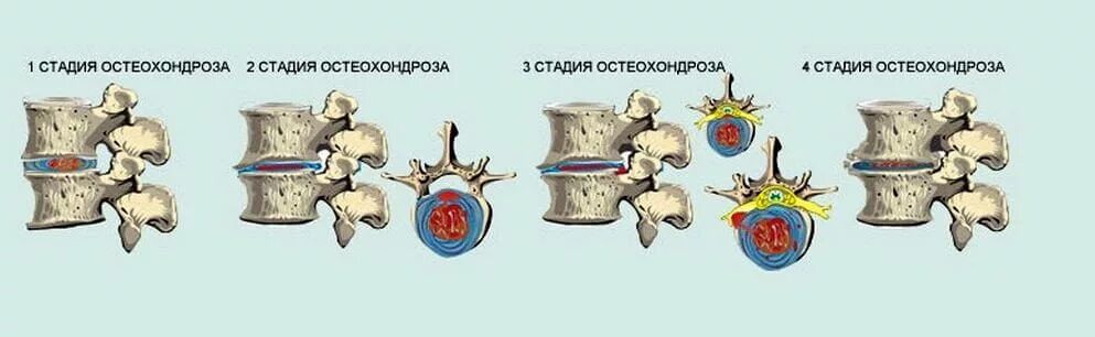 остеохондроз среднегрудного отдела позвоночника.