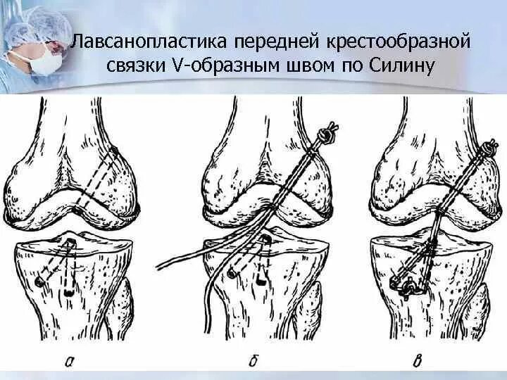 Лавсанопластика коленного сустава. Лавсанопластика связки коленного сустава. Пластика связок коленного сустава операция. Пластика крестообразной связки реабилитация. Передняя крестообразная связка после операции