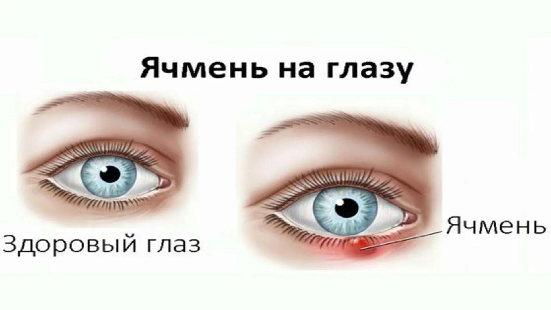 Ячмень что делать в домашних условиях. Заболевания век ячмень. Как выглядит ячмень на глазу.