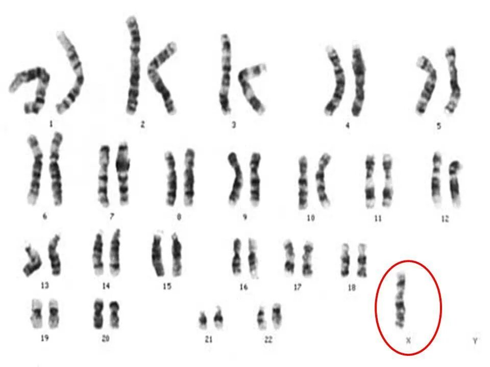 Появление дополнительной хромосомы. Синдром Шерешевского Тернера кариотип. Кариотип при синдроме Шерешевского-Тернера. Синдром Шерешевского кариотип. Синдром Шерешевского Тернера кариотип 45х.