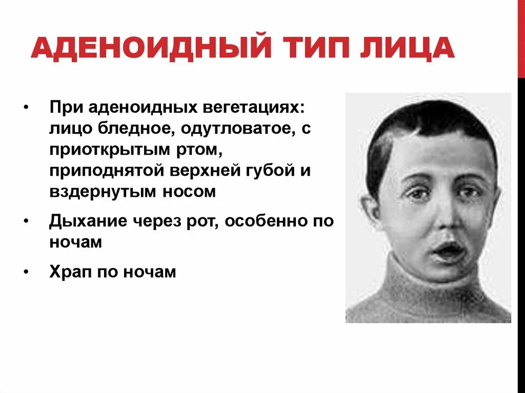 Дыхание открытым ртом. Тип лица при аденоидах у детей. Аденоидитное лицо у ребенка. Аденоидный Тип лица у детей.