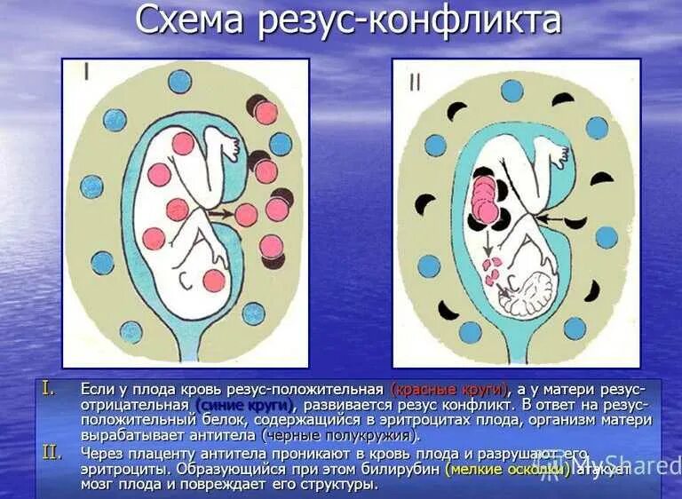 Первая отрицательная резус конфликт. Резус-конфликт при беременности матери и плода. последовательность стадий развития резус- конфликта. механизм развития резус конфликта схема. клинические проявления резус конфликта.